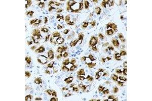 Immunohistochemical analysis of BPGM staining in human gastric cancer formalin fixed paraffin embedded tissue section. (BPGM 抗体)
