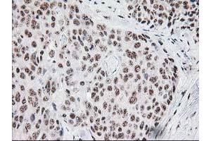 Immunohistochemical staining of paraffin-embedded Adenocarcinoma of Human breast tissue using anti-MGLL mouse monoclonal antibody. (MGLL 抗体)