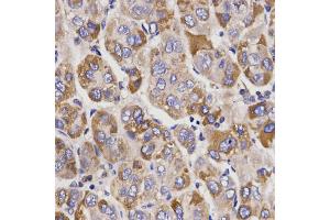 Immunohistochemistry of paraffin-embedded human liver cancer using UGT1A9 antibody. (UGT1A9 抗体)