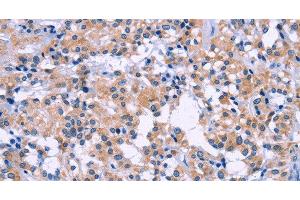 Immunohistochemistry of paraffin-embedded Human thyroid cancer tissue using DUSP22 Polyclonal Antibody at dilution 1:60 (DUSP22 抗体)