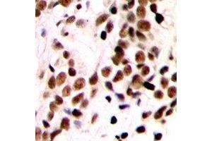 Immunohistochemical analysis of GTF2IRD1 staining in human breast cancer formalin fixed paraffin embedded tissue section.