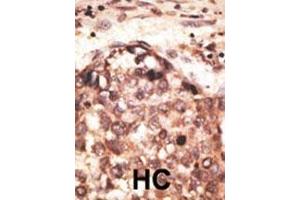 Formalin-fixed and paraffin-embedded human cancer tissue reacted with the primary antibody, which was peroxidase-conjugated to the secondary antibody, followed by AEC staining. (MMP8 抗体  (AA 286-315))