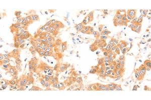 Immunohistochemistry of paraffin-embedded Human breast cancer using PRDX2 Polyclonal Antibody at dilution of 1:80 (Peroxiredoxin 2 抗体)