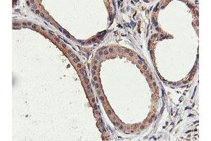 Immunohistochemical staining of paraffin-embedded Human breast tissue using anti-ILVBL mouse monoclonal antibody. (ILVBL 抗体)