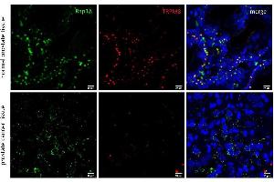 Representative confocal micrographs of healthy prostate tissue and prostate adenorcarcinoma (Gleason 5) microarrays (Biomax Inc. (RAP1A 抗体  (Center))