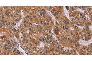 Immunohistochemistry of paraffin-embedded Human liver cancer tissue using CALCA Polyclonal Antibody at dilution 1:40 (CGRP 抗体)