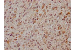 IHC image of ABIN7166521 diluted at 1:300 and staining in paraffin-embedded human glioma cancer performed on a Leica BondTM system. (PCDHa8 抗体  (AA 719-922))