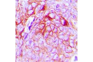 Immunohistochemical analysis of GPR34 staining in human breast cancer formalin fixed paraffin embedded tissue section. (GPR34 抗体  (Center))