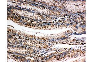 Anti-Gelsolin antibody, IHC(P) IHC(P): Human Intestinal Cancer Tissue (Gelsolin 抗体  (C-Term))