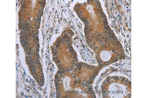 Immunohistochemistry of Human colon cancer using TNFRSF13C Polyclonal Antibody at dilution of 1:40 (TNFRSF13C 抗体)