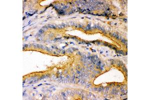 Anti- TJP1 antibody, IHC(P) IHC(P): Human Intestinal Cancer Tissue (TJP1 抗体  (AA 1178-1527))