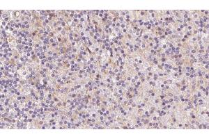 ABIN6273082 at 1/100 staining Human lymph cancer tissue by IHC-P. (Tropomodulin 4 抗体  (Internal Region))