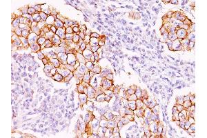 Formalin-fixed, paraffin-embedded human Breast Carcinoma stained with Phosphotyrosine Mouse Monoclonal Antibody (PY20). (Phosphotyrosine 抗体)