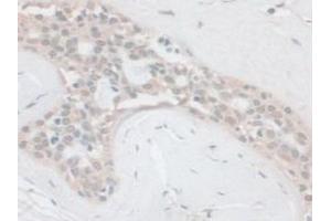 IHC-P analysis of Human Breast Cancer Tissue, with DAB staining. (PCSK1 抗体  (AA 500-738))
