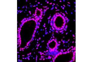 Immunofluorescence of paraffin embedded human breast cancer using smad62024 (ABIN7075629) at dilution of 1:1000 (400x lens) (SMAD6 抗体)