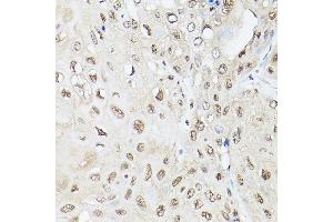 Immunohistochemistry of paraffin-embedded human esophageal cancer using UBQLN2 Rabbit pAb (ABIN6127815, ABIN6149859, ABIN6149860 and ABIN6225041) at dilution of 1:250 (40x lens). (Ubiquilin 2 抗体  (AA 1-150))
