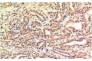 Immunohistochemistry of paraffin-embedded Human stomach carcinoma tissue using CHOP Monoclonal Antibody at dilution of 1:200. (DDIT3 抗体)