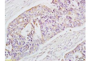 Formalin-fixed and paraffin-embedded human rectal carcinoma labeled with Rabbit Anti-EpCAM Polyclonal Antibody , Unconjugated 1:200 followed by conjugation to the secondary antibody and DAB staining