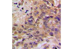 Immunohistochemical analysis of p53 (pS37) staining in human breast cancer formalin fixed paraffin embedded tissue section. (p53 抗体  (N-Term, pSer37))