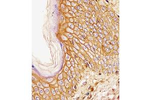 CD44 antibody (ABIN659120 and ABIN2843760) immunohistochemistry analysis in formalin fixed and paraffin embedded human esophagus carcinoma followed by peroxidase conjμgation of the secondary antibody and DAB staining. (CD44 抗体)