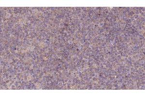 ABIN6273139 at 1/100 staining Human lymph cancer tissue by IHC-P. (MEST 抗体  (C-Term))