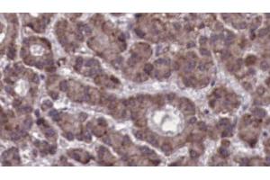 ABIN6273923 at 1/100 staining Human liver cancer tissue by IHC-P. (CCKBR 抗体  (N-Term))