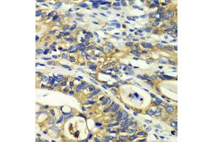 Immunohistochemistry of paraffin-embedded human colon carcinoma using RPH3A antibody (ABIN6128668, ABIN6147094, ABIN6147096 and ABIN6217639) at dilution of 1:100 (40x lens). (RPH3A 抗体  (AA 1-280))
