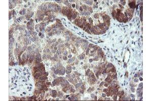 Immunohistochemical staining of paraffin-embedded Adenocarcinoma of Human ovary tissue using anti-TBCC mouse monoclonal antibody. (TBCC 抗体)