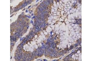 Immunohistochemistry of paraffin-embedded Human rectum cancer using EPHX2 Polyclonal Antibody at dilution of 1:200 (40x lens). (EPHX2 抗体)