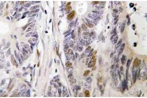 Immunohistochemistry (IHC) analyzes of c-Fos antibody in paraffin-embedded human colon carcinoma tissue. (c-FOS 抗体)
