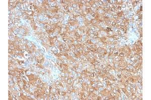 Formalin-fixed, paraffin-embedded human Prostate Carcinoma stained with CD63 Rabbit Recombinant Monoclonal Antibody (LAMP3/2990R). (Recombinant CD63 抗体)