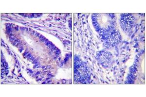 Immunohistochemistry analysis of paraffin-embedded human colon carcinoma tissue using eIF4B (Phospho-Ser422) antibody. (EIF4B 抗体  (pSer422))
