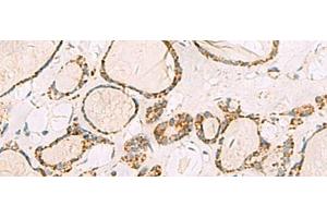 Immunohistochemistry of paraffin-embedded Human thyroid cancer tissue using ISOC2 Polyclonal Antibody at dilution of 1:95(x200) (ISOC2 抗体)