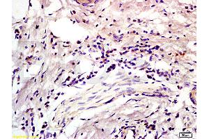 Formalin-fixed and paraffin embedded human colon carcinoma labeled with Anti-CD45RO Polyclonal Antibody, Unconjugated (ABIN733283) at 1:200 followed by conjugation to the secondary antibody and DAB staining (CD45RO 抗体)