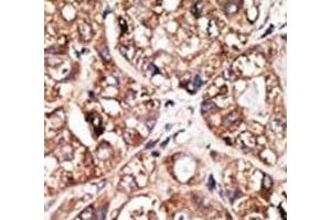 IHC analysis of FFPE human hepatocarcinoma tissue stained with the NeuroD1 antibody