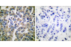Peptide - +Immunohistochemical analysis of paraffin-embedded human breast carcinoma tissue using HSP10 antibody (#C0230). (HSPE1 抗体)