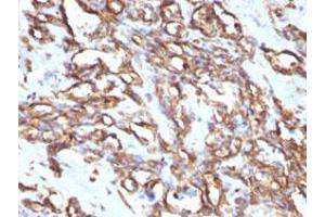 Immunohistochemical staining (Formalin-fixed paraffin-embedded sections) of human angiosarcoma with VIM monoclonal antibody, clone VM1170 . (Vimentin 抗体)