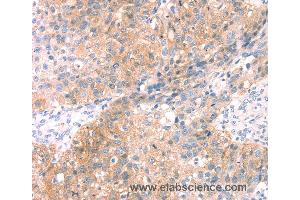 Immunohistochemistry of Human breast cancer using SNAP23 Polyclonal Antibody at dilution of 1:25 (SNAP23 抗体)