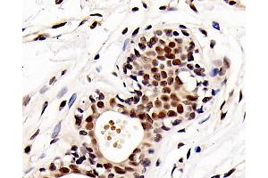 Immunohistochemistry analysis of paraffin-embedded human breast cancer using HDAC1 Polyclonal Antibody at dilution of 1:300. (HDAC1 抗体)