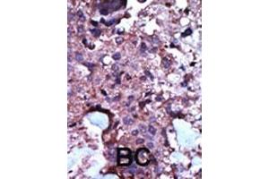 Formalin-fixed and paraffin-embedded human cancer tissue reacted with the primary antibody, which was peroxidase-conjugated to the secondary antibody, followed by AEC staining. (PKLR 抗体  (N-Term))