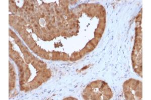Formalin-fixed, paraffin-embedded human Prostate Carcinoma stained with Lactoylglutathione Lyase Mouse Monoclonal Antibody (CPTC-GLO1-3). (GLO1 抗体)