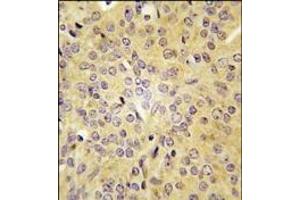 Formalin-fixed and paraffin-embedded human prostata carcinoma tissue reacted with LARS antibody (C-term), which was peroxidase-conjugated to the secondary antibody, followed by DAB staining. (LARS 抗体  (C-Term))