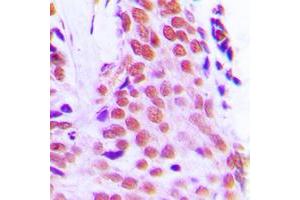 Immunohistochemical analysis of RPL28 staining in human breast cancer formalin fixed paraffin embedded tissue section. (RPL28 抗体  (Center))