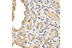 Immunohistochemistry of paraffin-embedded human kidney cancer using ARRB2 antibody at dilution of 1:200 (400x lens). (Arrestin 3 抗体)