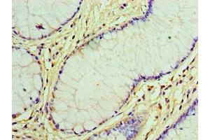 Immunohistochemistry of paraffin-embedded human colon cancer using ABIN7153892 at dilution of 1:100 (GCKR 抗体  (AA 1-625))
