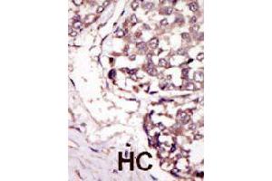 Formalin-fixed and paraffin-embedded human hepatocellular carcinoma tissue reacted with RYK polyclonal antibody  , which was peroxidase-conjugated to the secondary antibody, followed by DAB staining. (RYK 抗体  (C-Term))