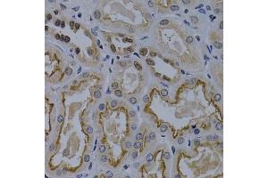 Immunohistochemistry of paraffin-embedded human kidney cancer using TNFRSF6B antibody (ABIN5970241) at dilution of 1/200 (40x lens). (TNFRSF6B 抗体)