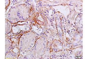 Formalin-fixed and paraffin embedded human esophageal carcinoma labeled Anti-Collagen II Polyclonal Antibody, Unconjugated (ABIN672171) at 1:200, followed by conjugation to the secondary antibody and DAB staining (COL2 抗体  (AA 1201-1300))