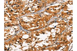 The image on the left is immunohistochemistry of paraffin-embedded Human thyroid cancer tissue using ABIN7190457(DEFA1/3 Antibody) at dilution 1/30, on the right is treated with synthetic peptide. (DEFA1/DEFA3 抗体)