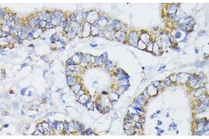 Immunohistochemistry of paraffin-embedded Human colon carcinoma using PDHA1 Polyclonal Antibody at dilution of 1:200 (40x lens). (PDHA1 抗体)